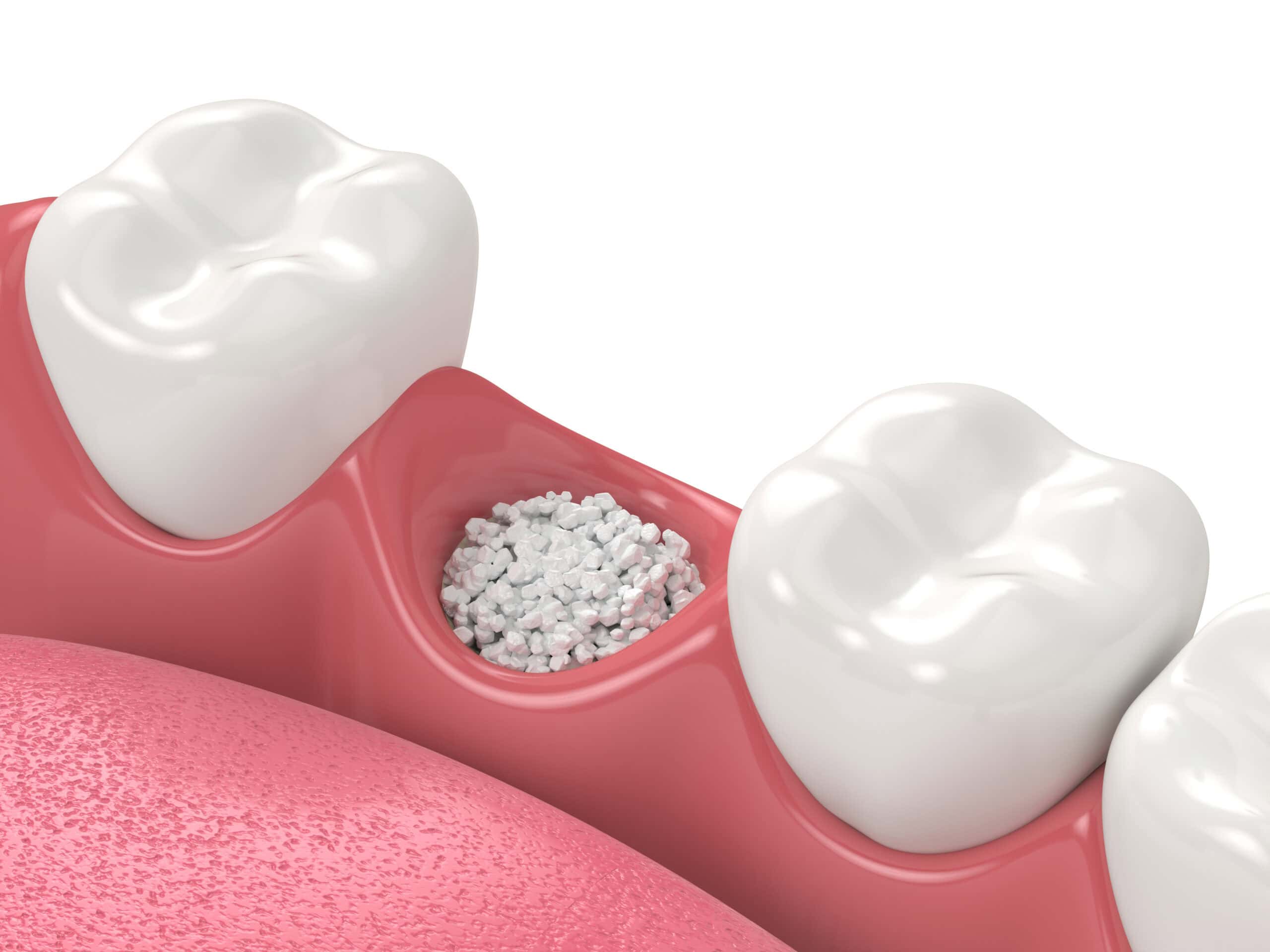 3D render of dental bone grafting with dental bone biomaterial